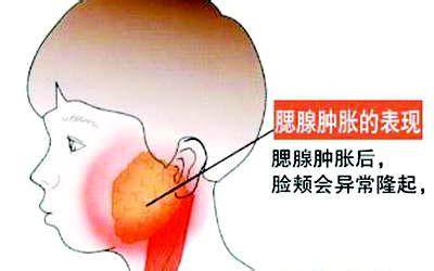 腮腺肿瘤最新治疗方法概述