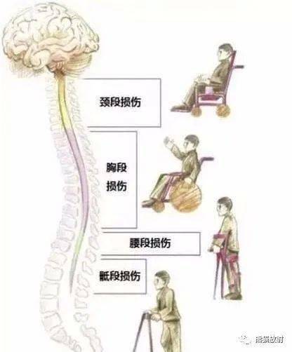 脊髓损伤最新进展概览