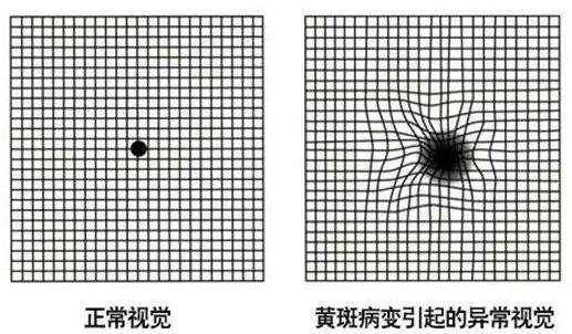 黄斑病变最新有效治疗方法研究揭秘